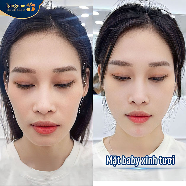 Kết quả khách hàng sau khi cấy mỡ mặt tại Kangnam