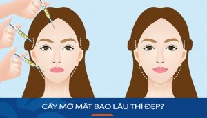 Cấy mỡ mặt bao lâu thì đẹp? Những lưu ý cần nhớ sau khi cấy mỡ