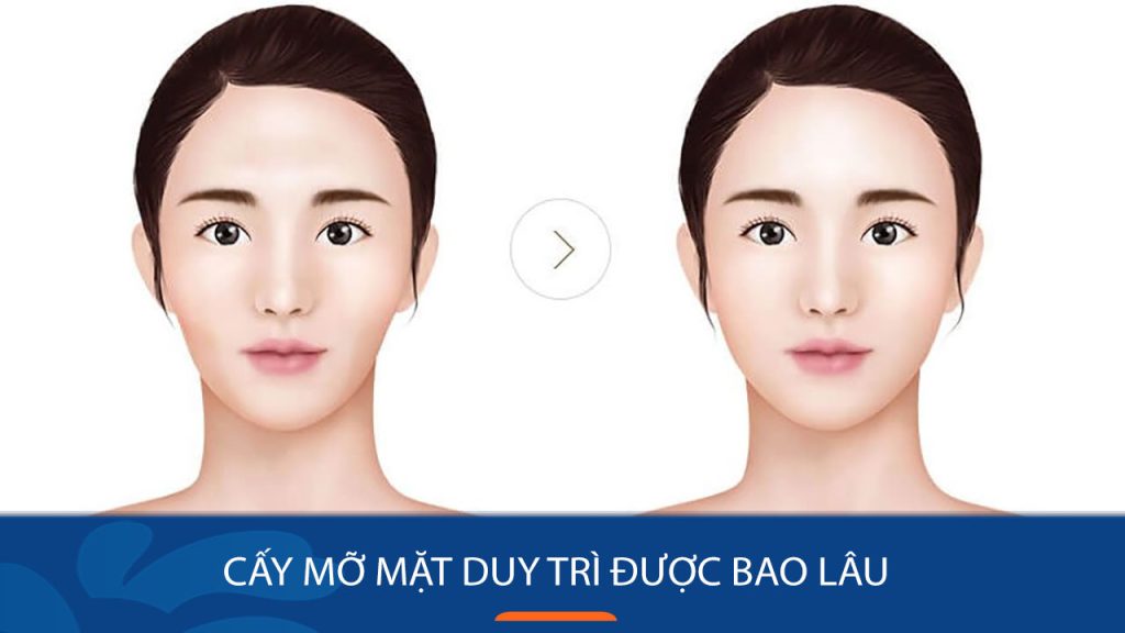 Cấy mỡ mặt duy trì được bao lâu? Những yếu tố ảnh hưởng