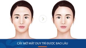 Cấy mỡ mặt duy trì được bao lâu? Những yếu tố ảnh hưởng