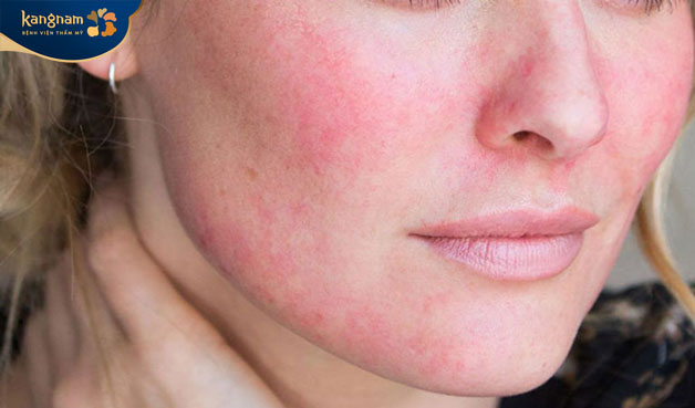 Sau laser da bị ửng đỏ nên cần phải chăm sóc cẩn thận