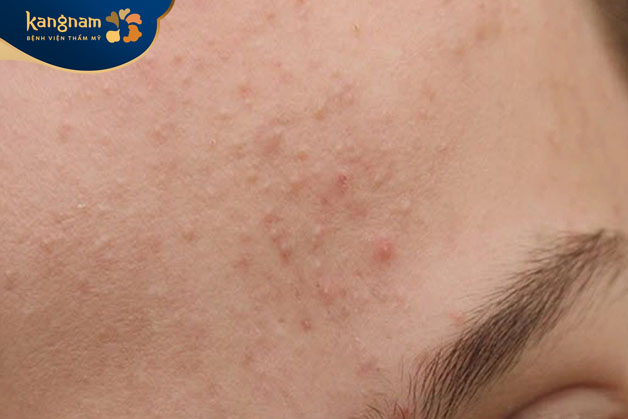 Da mặt nổi mụn cám sần sùi, kém mịn màng do nhiều nguyên nhân khác nhau
