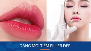 Top 10 dáng môi tiêm filler đẹp nhất hiện nay
