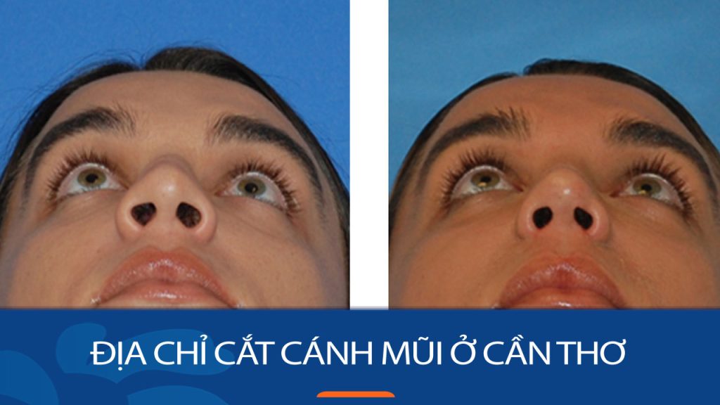 Địa chỉ cắt cánh mũi kangnam Cần Thơ – Mũi xinh mềm mại, thanh tú