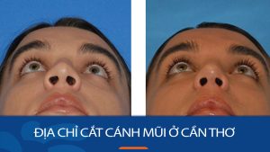 Địa chỉ cắt cánh mũi kangnam Cần Thơ – Mũi xinh mềm mại, thanh tú