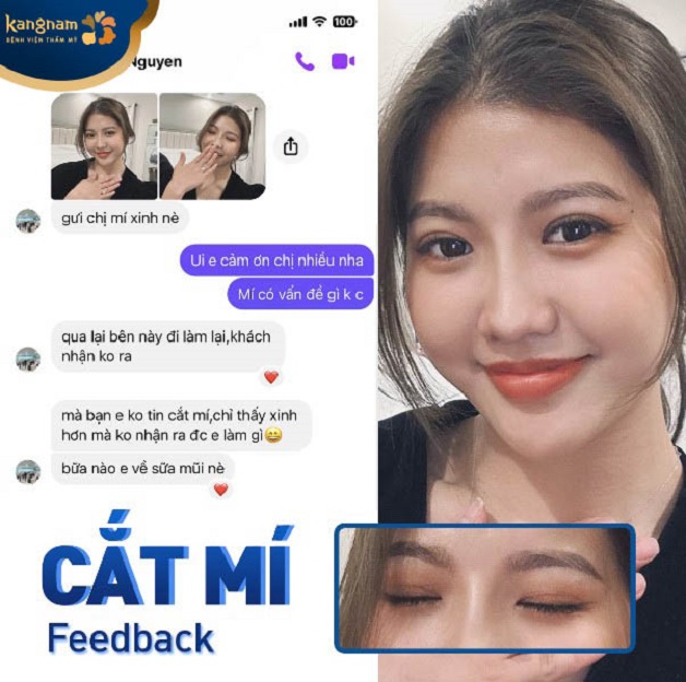 Khách hàng Sara Nguyễn - Việt Kiều Mỹ gửi feedback, tự tin khoe nếp mí mới