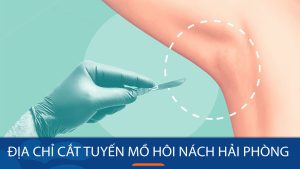 Địa chỉ cắt tuyến mồ hôi nách ở Hải Phòng: Công nghệ hiện đại, bác sĩ chuyên nghiệp
