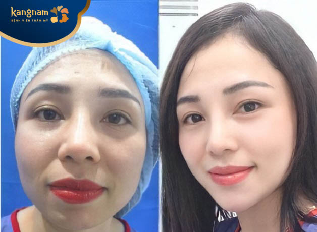 Chị Khánh Vân khoe kết quả độn cằm tại Kangnam Cần Thơ