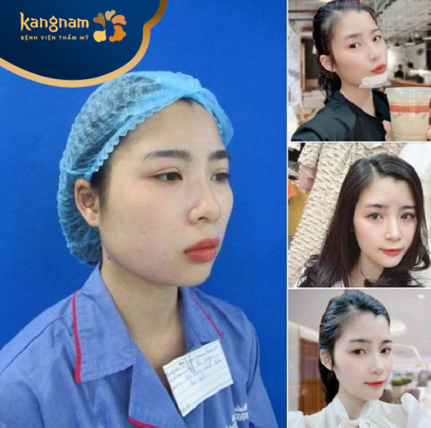 Chị Trịnh Tú cập nhật hình ảnh thay đổi sau độn cằm