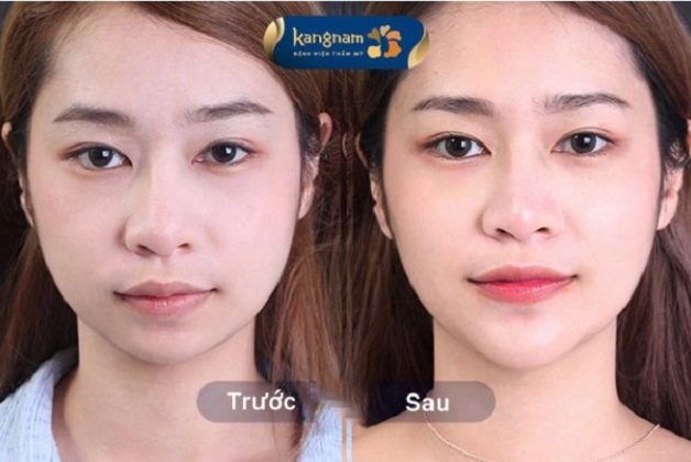 Bạn Hà Lê tự tin khoe hình ảnh sau độn cằm 2 tháng