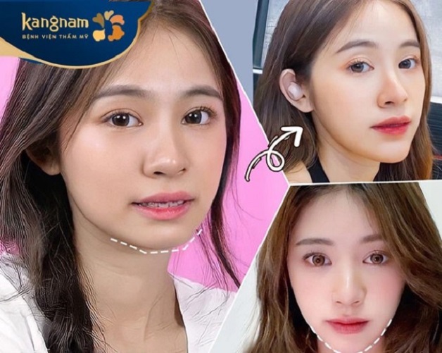 Bạn Quỳnh Anh với gương mặt thon gọn, cằm V-line