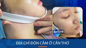 Độn cằm kangnam Cần Thơ