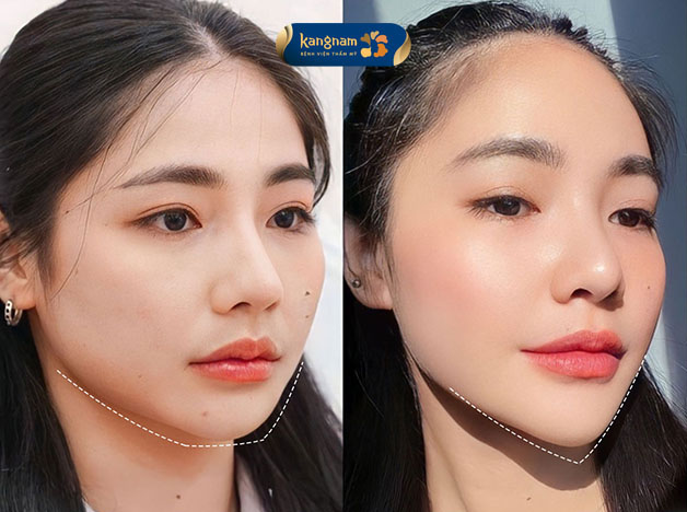 Cằm chuẩn Vline hài hòa với các đường nét trên gương mặt