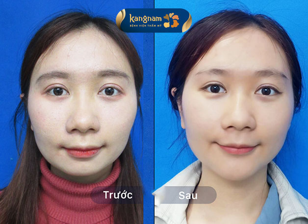 Sau khi độn cằm, khuôn mặt thanh thoát, mềm mại không còn thô như trước