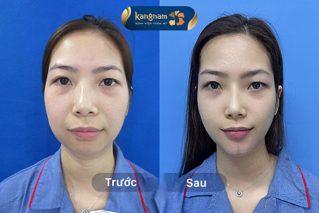 Khuôn mặt khách hàng sau khi thực hiện độn cằm ở Kangnam