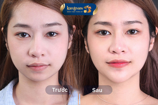 Cằm Vline chuẩn đẹp tự nhiên