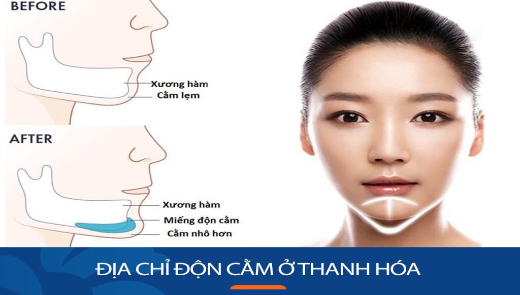 Độn cằm kangnam Thanh Hóa