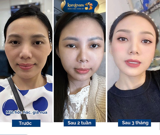 Gương mặt không còn hốc hác sau 3 tháng thực hiện 
