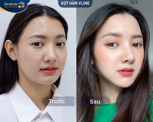 Dưới đôi bàn tay vàng của bác sĩ Kangnam, các đường nét hài hòa với khuôn mặt