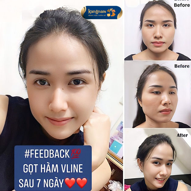 Sự thay đổi hoàn toàn sau khi gọt hàm tại Kangnam