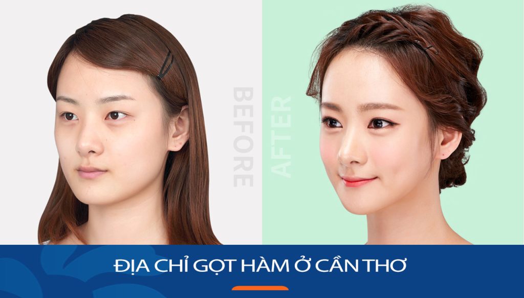 Gọt hàm kangnam Cần Thơ