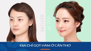 Gọt hàm kangnam Cần Thơ