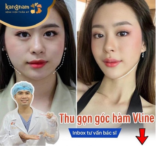 Gọt hàm Vline 3D