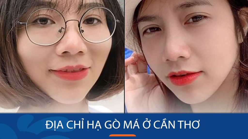Hạ gò má kangnam Cần Thơ