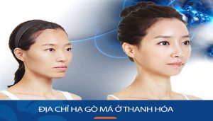 Địa chỉ hạ gò má kangnam Thanh Hóa