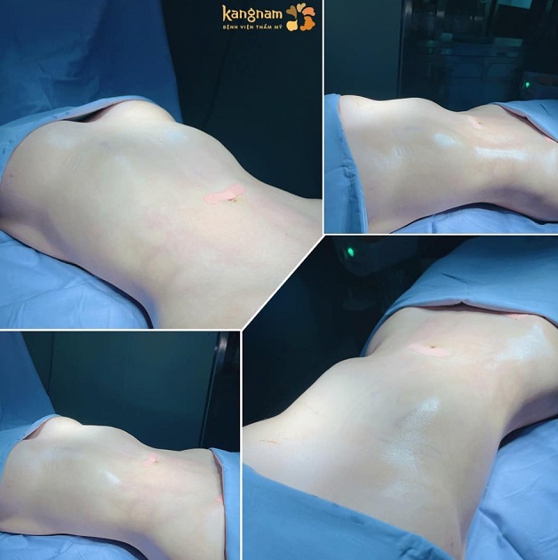 Dịch vụ giảm mỡ bụng