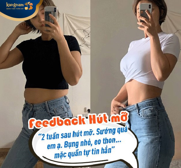 Bạn Thúy Vân Feedback sau hút mỡ 2 tuần