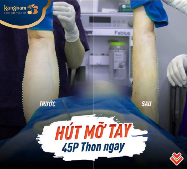 Giảm mỡ bắp tay 45 phút thon gọn ngay