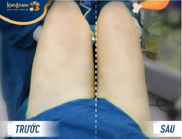 Giảm mỡ đùi nhanh chóng với công nghệ cao