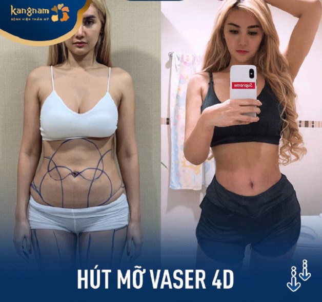 Công nghệ hút mỡ Vaser 4D