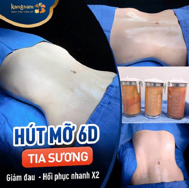 Công nghệ hút mỡ Vaser 6D