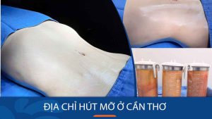 Hút mỡ kangnam Cần Thơ