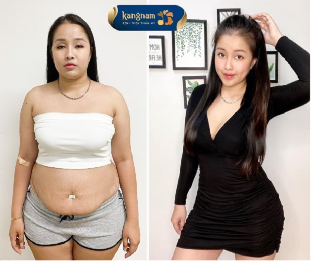 Bạn Trâm Anh chia sẻ sau hút mỡ tại Kangnam.