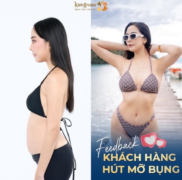 Bạn Trâm Anh gửi hình ảnh trước và sau hút mỡ