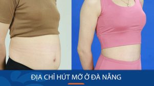Hút mỡ kangnam Đà Nẵng