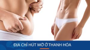 Hút mỡ kangnam Thanh Hóa