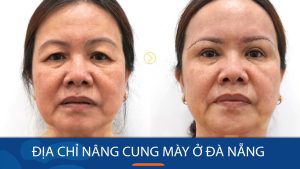 Kangnam địa chỉ nâng cung mày ở Đà Nẵng chất lượng, kết quả đẹp như ý!