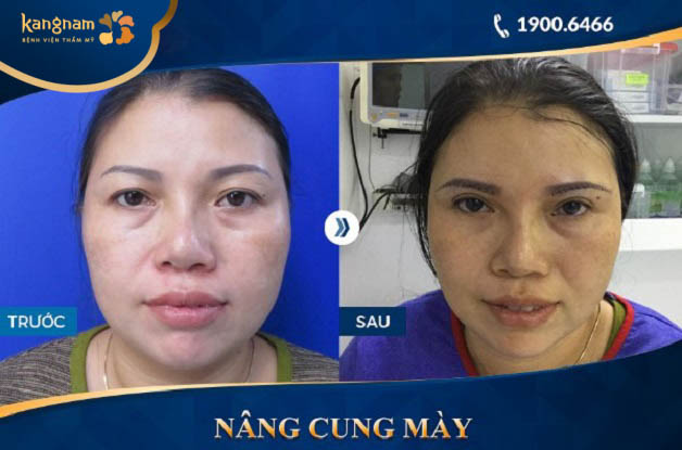 Chị Nguyễn Hợp hài lòng với kết quả thẩm mỹ sau nâng cung chân mày