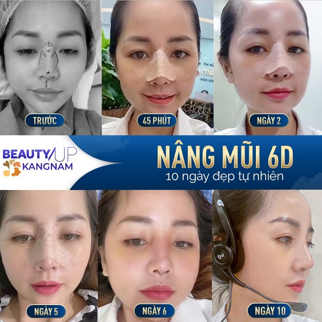 Nâng mũi 6D không đau 10 ngày đẹp tự nhiên
