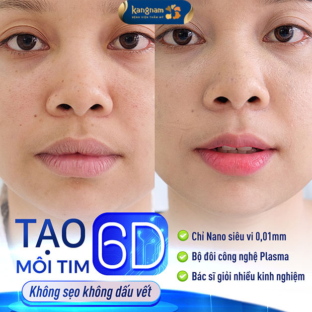 Công nghệ 6D giúp bờ môi tự nhiên, mềm mại không lộ sẹo 