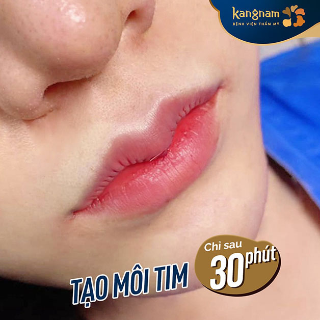 Kết quả ngay sau khi tạo hình môi tim tại Kangnam đẹp, mềm mại 