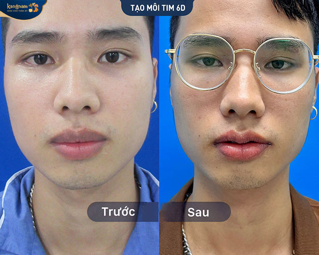 Cận cảnh kết quả của khách hàng nam sau khi tạo hình môi tim 