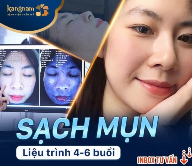 Dịch vụ trị mụn De-Acne điều trị dứt điểm chỉ với liệu trình 4-6 buổi