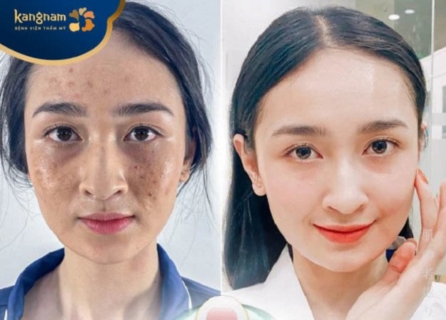 Bạn Thủy Tiên trị mụn trứng cá tại Kangnam đã được 5 tháng