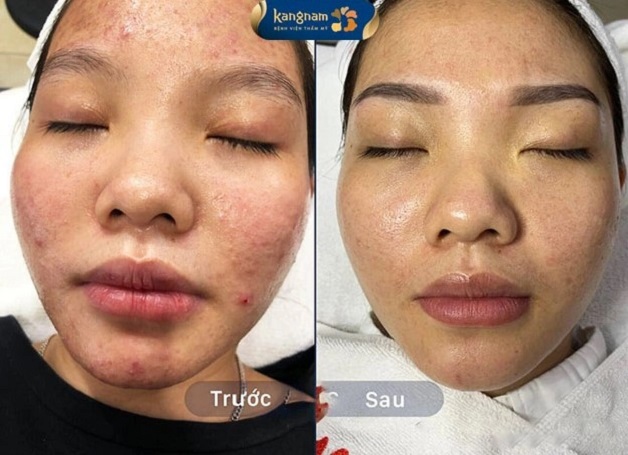 Thùy Hương sau trị mụn tại Viện thẩm mỹ Kangnam Cần Thơ