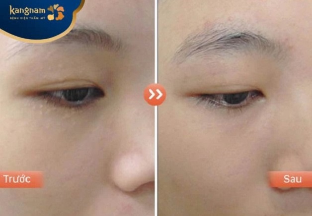 Chị Thùy Trang điều trị mụn thịt tại Kangnam